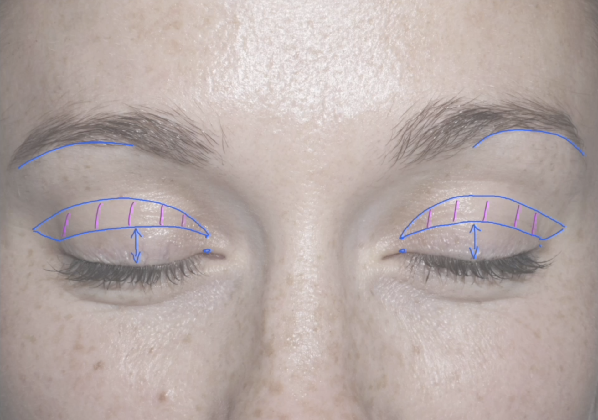 Image of a patient showing the markings for blepharoplasty